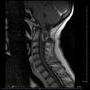 1A2 Cyst, neurenteric (Case 1) T1 with GAD