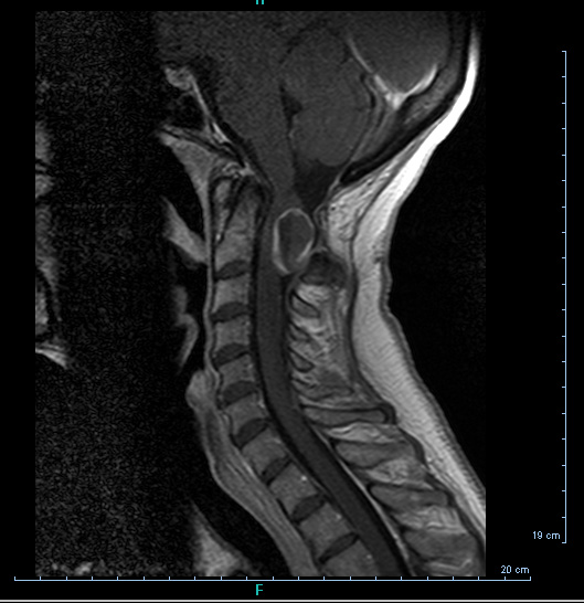 1A2 Cyst, neurenteric (Case 1) T1 with GAD