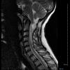 1A3 Cyst, neurenteric (Case 1) T2