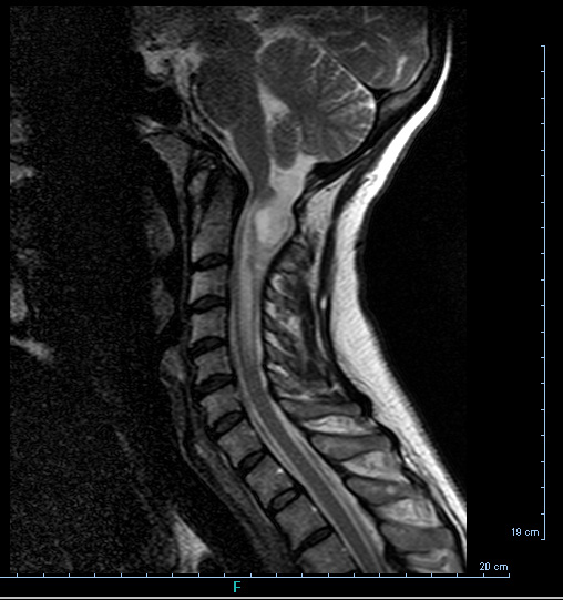 1A3 Cyst, neurenteric (Case 1) T2