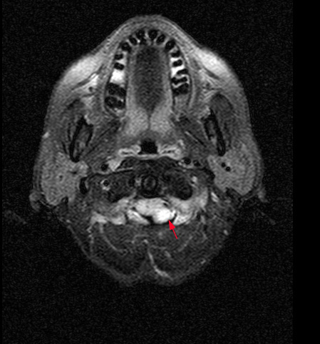 1A4 Cyst, neurenteric (Case 1) FLAIR