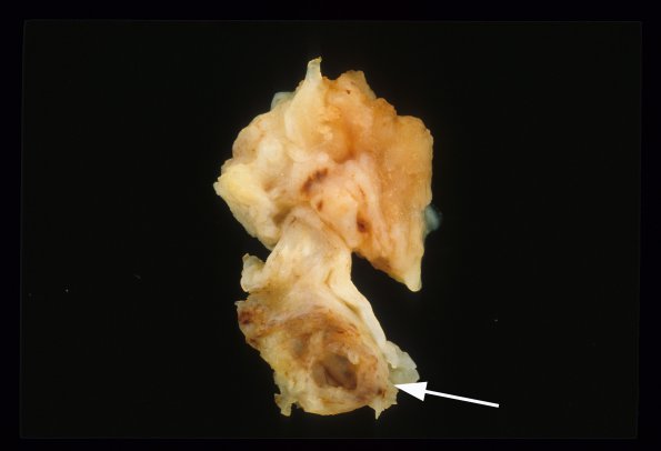 1B Cyst, neurenteric (Case 1) gross