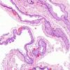 1C2 Cyst, Neurenteric (Case 1) H&E 5