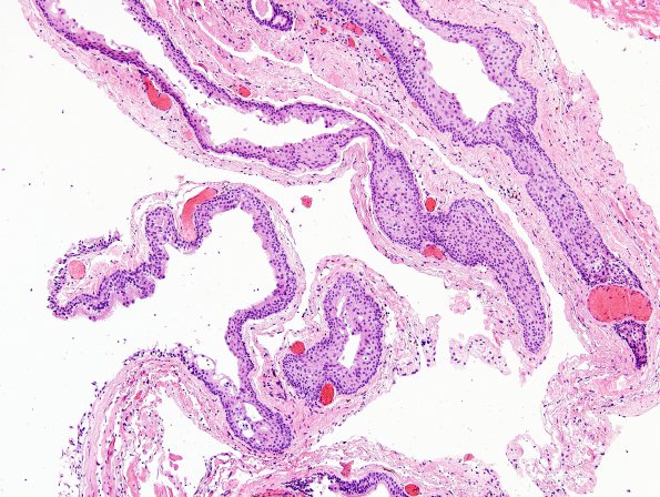 1C2 Cyst, Neurenteric (Case 1) H&E 5