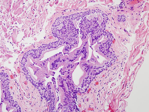 1C3 Cyst, Neurenteric (Case 1) H&E 4