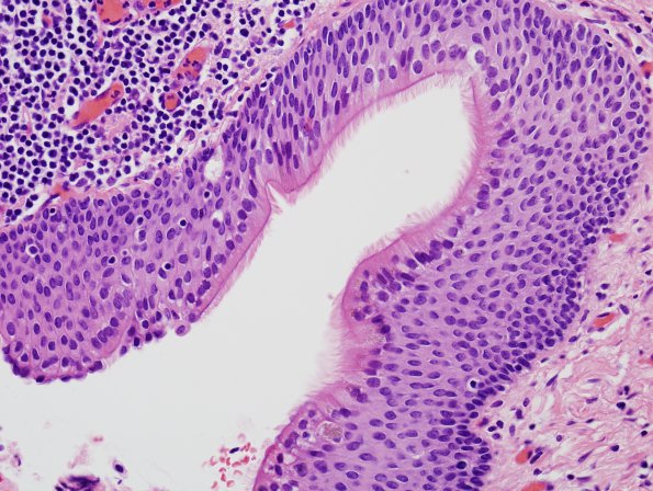 1C4 Cyst, Neurenteric (Case 1) H&E 2