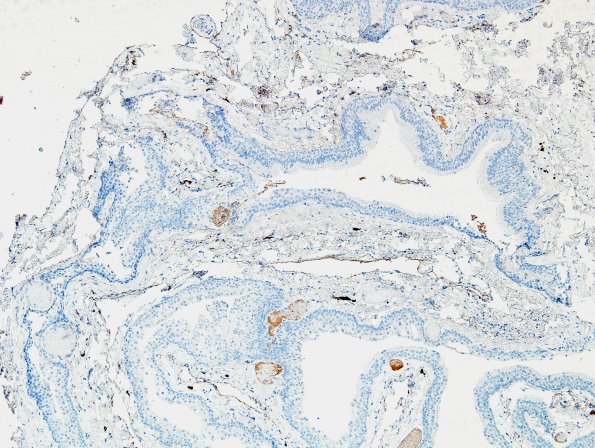 1D1 Cyst, Neurenteric (Case 1) GFAP 1