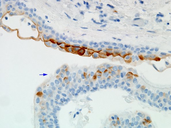 1D3 Cyst, neurenteric (Case 1) CEA 2