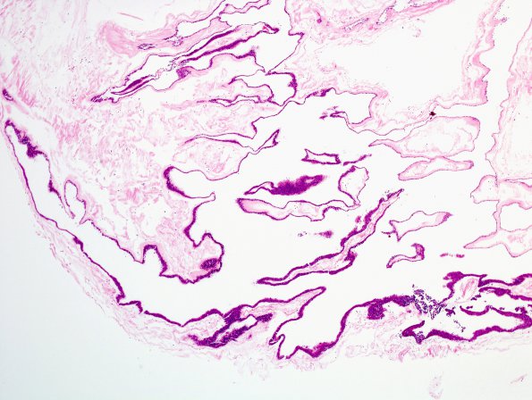 2B1 Cyst, neurenteric (Case 2) H&E 4