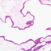 2B2 Cyst, neurenteric (Case 2) H&E 3