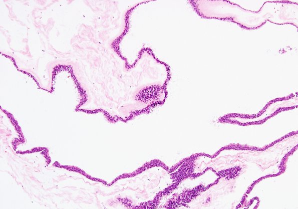 2B2 Cyst, neurenteric (Case 2) H&E 3