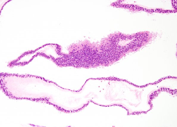 2B3 Cyst, neurenteric (Case 2) H&E 2