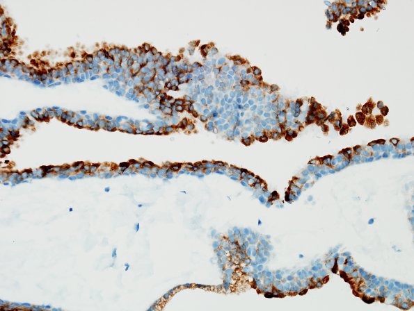 2C2 Cyst, neurenteric (Case 2) EMA 1