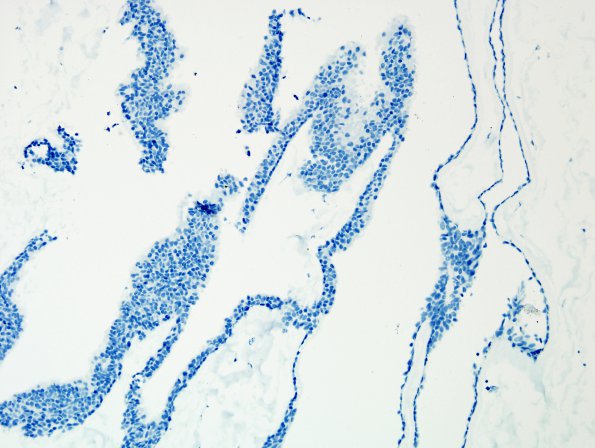 2C3 Cyst, neurenteric (Case 2) GFAP 1