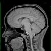 3A1 cyst, neurenteric (Case 3) T1 2