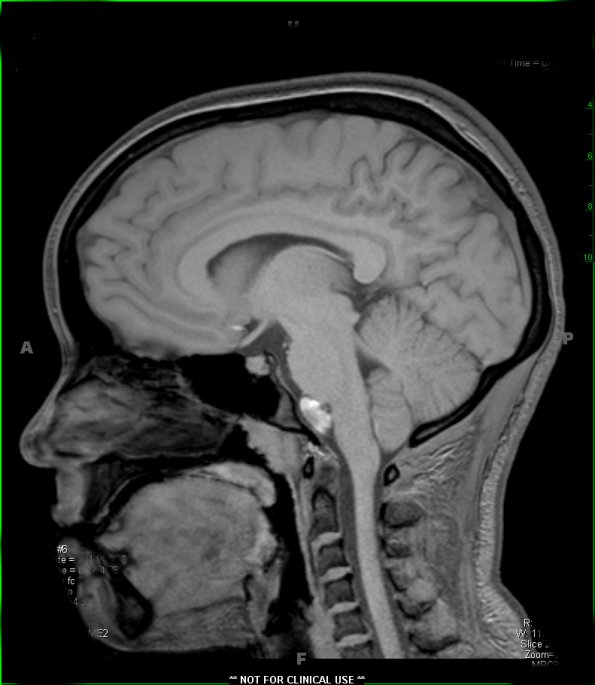 3A1 cyst, neurenteric (Case 3) T1 2