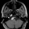 3A2 cyst, neurenteric (Case 3) T1 3