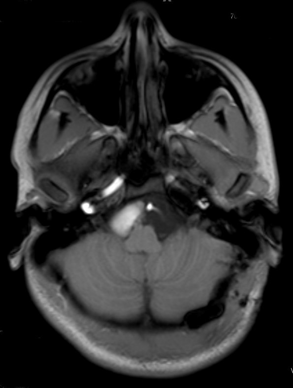 3A2 cyst, neurenteric (Case 3) T1 3