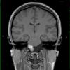 3A3 cyst, neurenteric (Case 3) T1