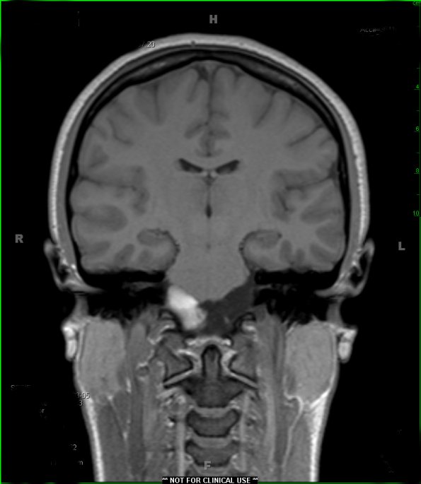 3A3 cyst, neurenteric (Case 3) T1