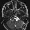 3A4 cyst, neurenteric (Case 3) T2 3