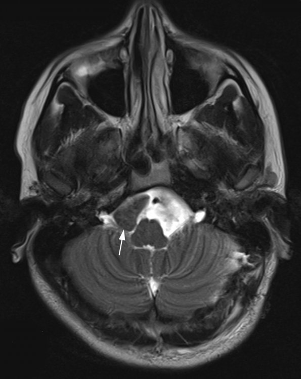 3A4 cyst, neurenteric (Case 3) T2 3