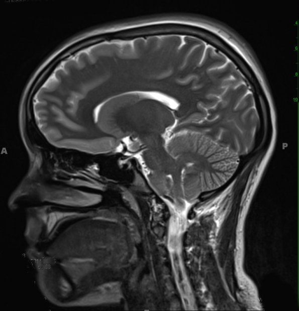 3A5 cyst, neurenteric (Case 3) T2 1