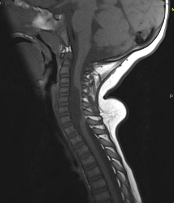 4A1 Cyst, enterogenous (Case 4) T1