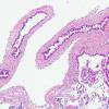 4B1 Cyst, enterogenous (Case 4) H&E 1