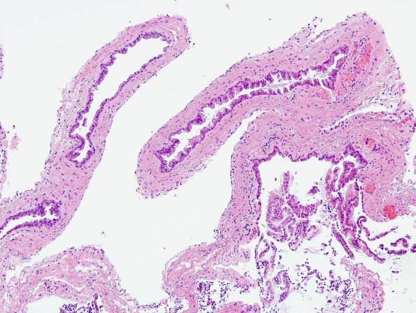 4B1 Cyst, enterogenous (Case 4) H&E 1