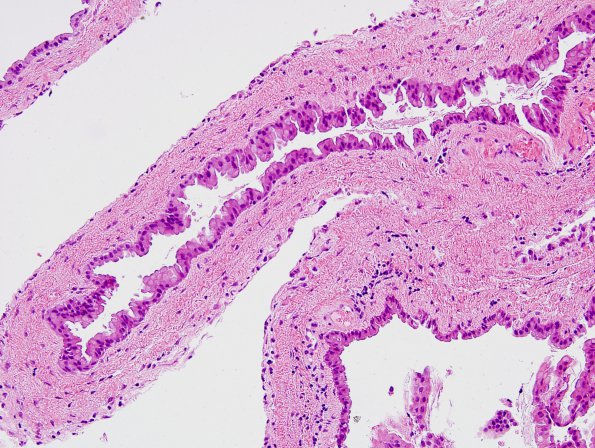 4B2 Cyst, enterogenous (Case 4) H&E 2