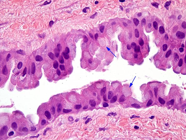 4B3 Cyst, enterogenous (Case 4) H&E 3