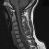 5A1 Cyst, neurenteric (Case 5) T1