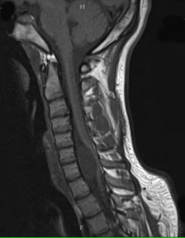 5A1 Cyst, neurenteric (Case 5) T1