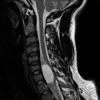 5A2 Cyst, neurenteric (Case 5) T2