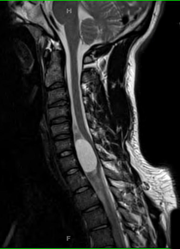 5A2 Cyst, neurenteric (Case 5) T2