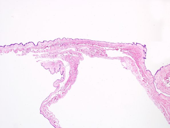 5B1 Cyst, neurenteric (Case 5) H&E 2