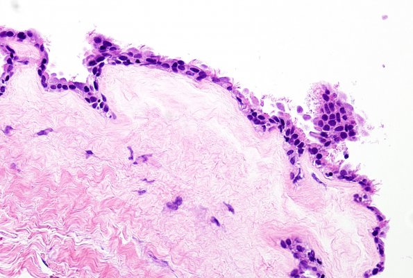 5B2 Cyst, neurenteric (Case 5) H&E 1