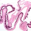 6A1 Cyst, Neurenteric (Case 6) 1