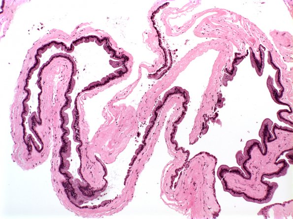 6A1 Cyst, Neurenteric (Case 6) 1