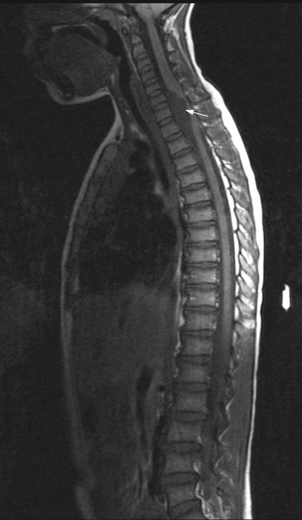 7A1 Cyst, neurenteric (Case 7) T1 2