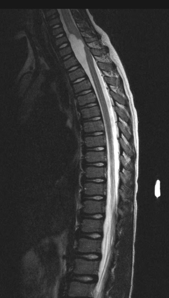 7A2 Cyst, neurenteric (Case 7) T2 2