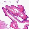 7B1 Cyst, neurenteric (Case 7) H&E 1