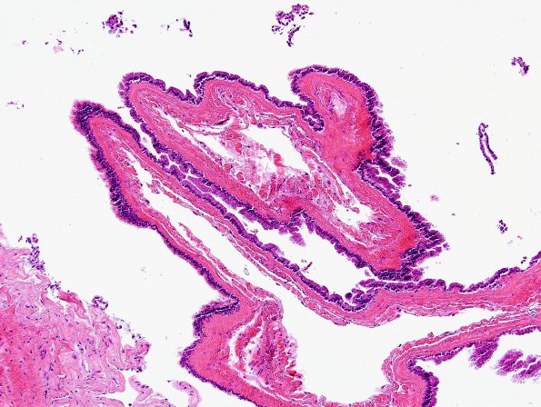 7B1 Cyst, neurenteric (Case 7) H&E 1