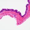 7B2 Cyst, neurenteric (Case 7) H&E 2