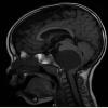 8A1 Cyst, neurenteric & Squamous metaplasia (Case 8) H&E Sagittal Flair T1