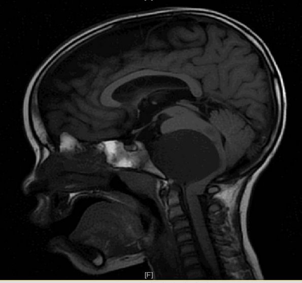 8A1 Cyst, neurenteric & Squamous metaplasia (Case 8) H&E Sagittal Flair T1