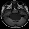 8A2 Cyst, neurenteric & Squamous metaplasia (Case 8) Flair