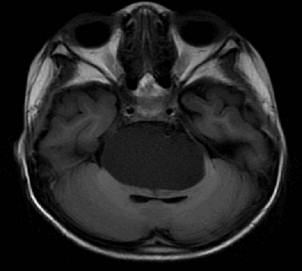 8A2 Cyst, neurenteric & Squamous metaplasia (Case 8) Flair