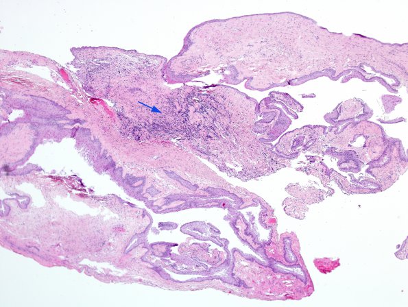 8B1 Cyst, neurenteric & Squamous metaplasia (Case 8) H&E 1